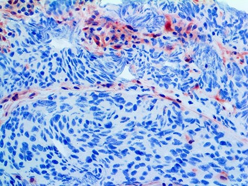 IHC of PTEN on an FFPE Prostate Carcinoma Tissue